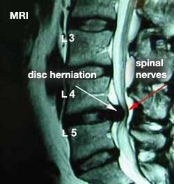 spinaldecom_2_mri